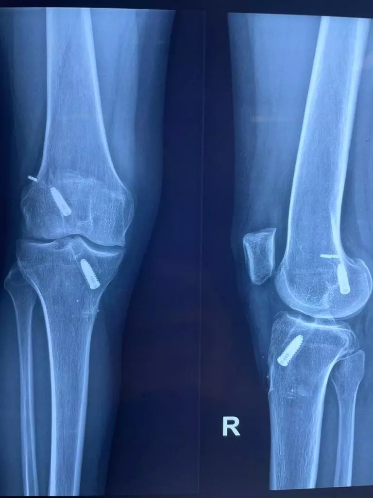 Revision ACL Reconstruction X-ray