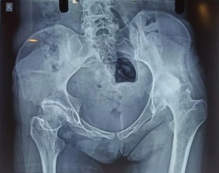 Computer Navigated Complex Total Hip Replacement X-ray