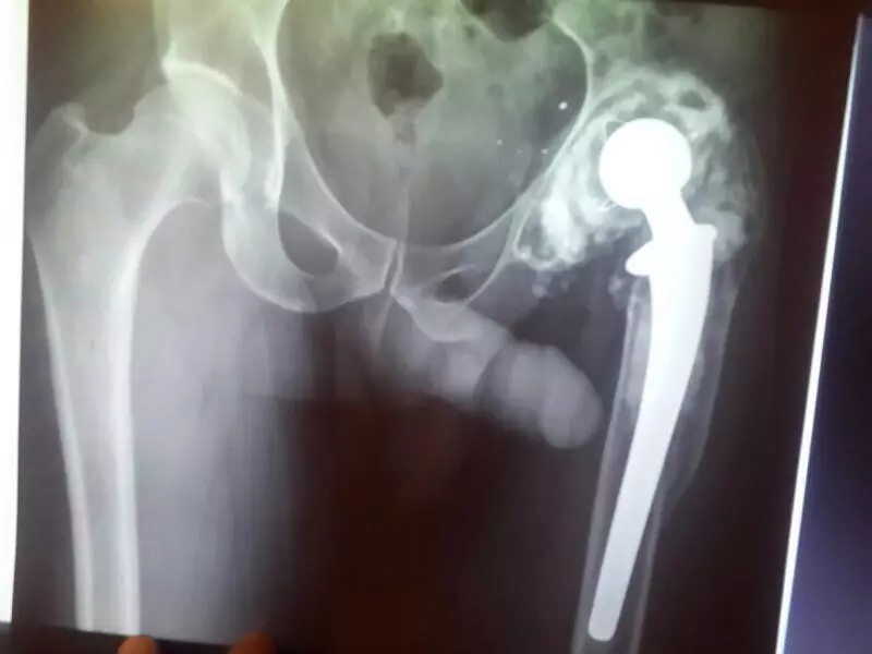 Revision Hip Surgery X-ray