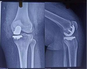 Computer Navigates Half Knee Replacement X-ray