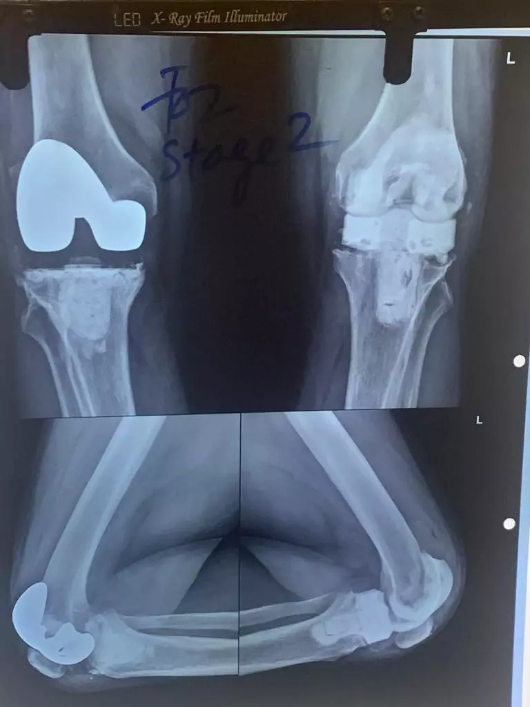 Revision Knee Surgery X-ray