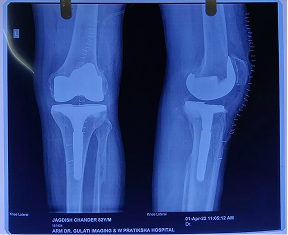 Computer Navigated Total Knee Replacement X-ray