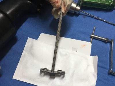 Puddu plate used in high tibial osteotomy