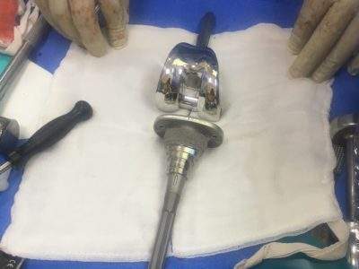 Sleeve stem technology used in complex Total knee replacement