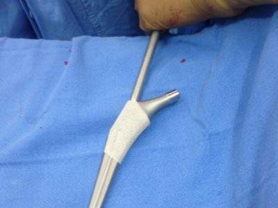 UNCEMENTED FEMORAL IMPLANT