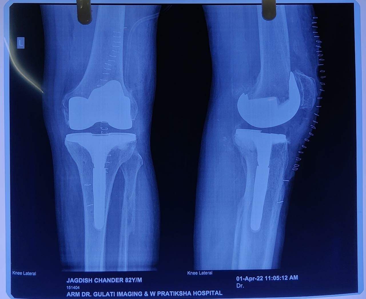 Computer Navigated Total Knee Replacement