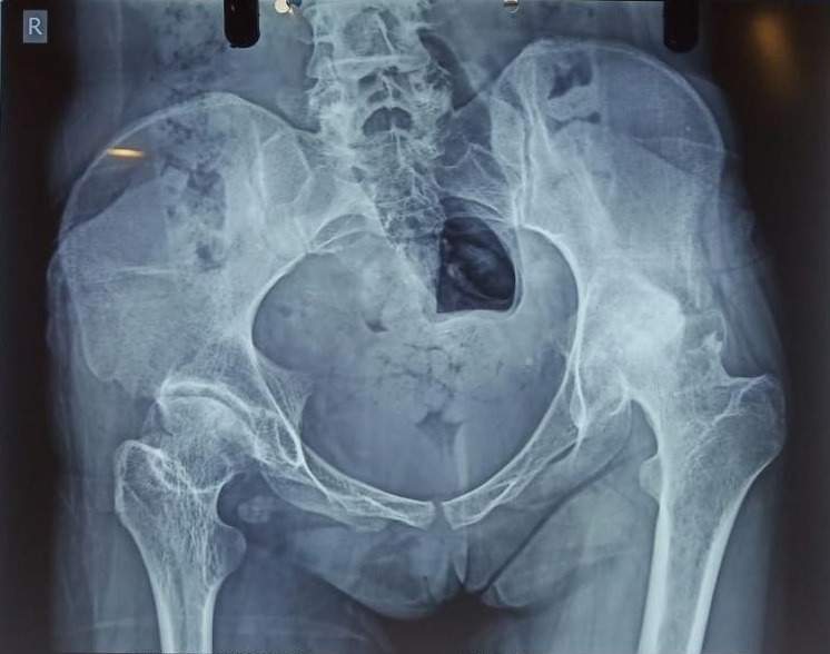 Computer Navigated Complex Total Hip Replacement