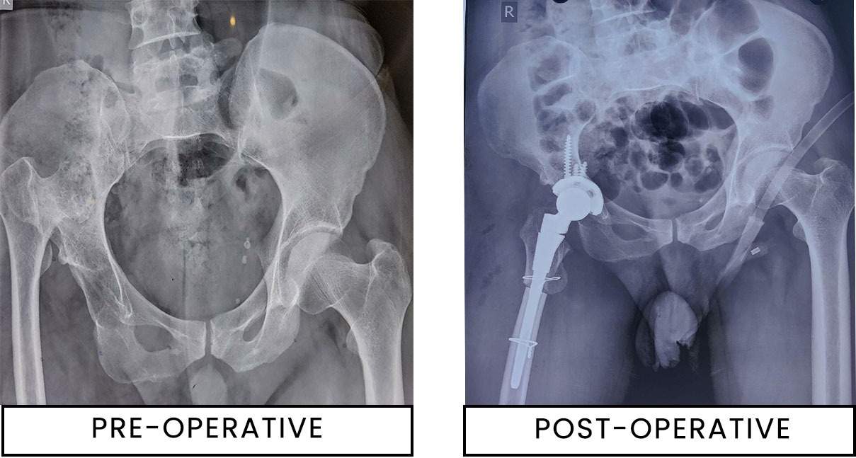 Total hip replacement in patients with hip dysplasia from birth