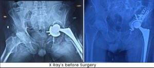 X Rays before surgery